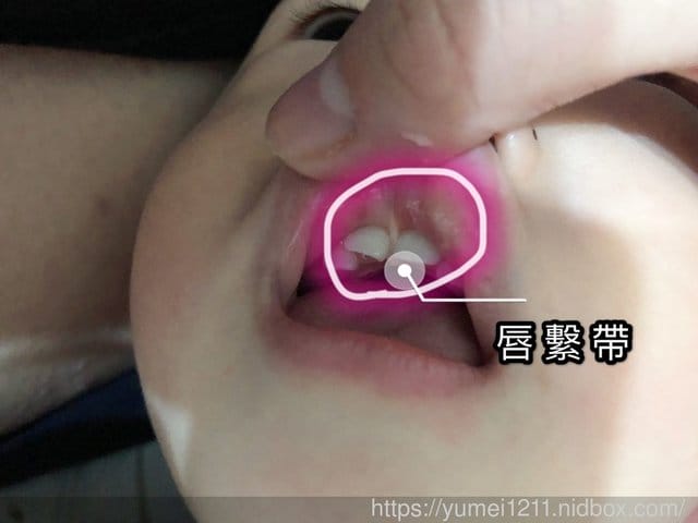 【虎寶1Y2M第一次的牙醫,被告知唇繫帶過緊…….會影響咬合不正】 - 第6張圖 【虎寶1Y2M第一次的牙醫,被告知唇繫帶過緊…….會影響咬合不正】